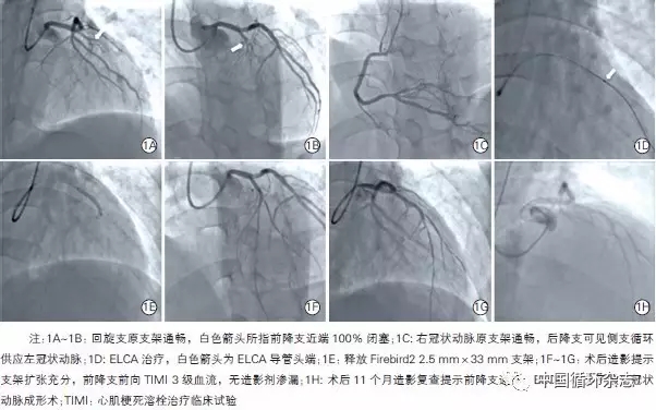 阜外医院新技术治疗闭塞病变,准分子激光可消